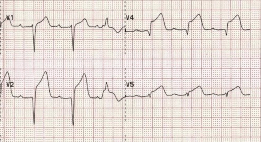 What is a STEMI in German?