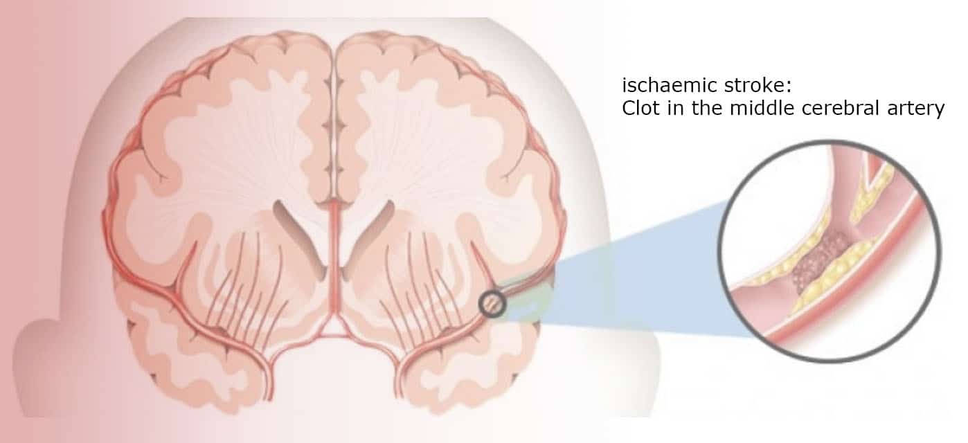 The future of stroke treatment